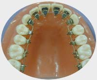Ortonorm Ortodonti Az ve Di Sal Poliklinii, ortodontist, ortodonti uzman, ortodonti, arpk di, arpk diler, ene bozukluu, dihekimi, dii, di hekimi, bozuk eneler, ene bozukluu, di, tel tedavisi, di arpkl